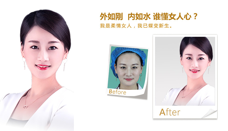 秦皇岛V脸、线雕隆鼻